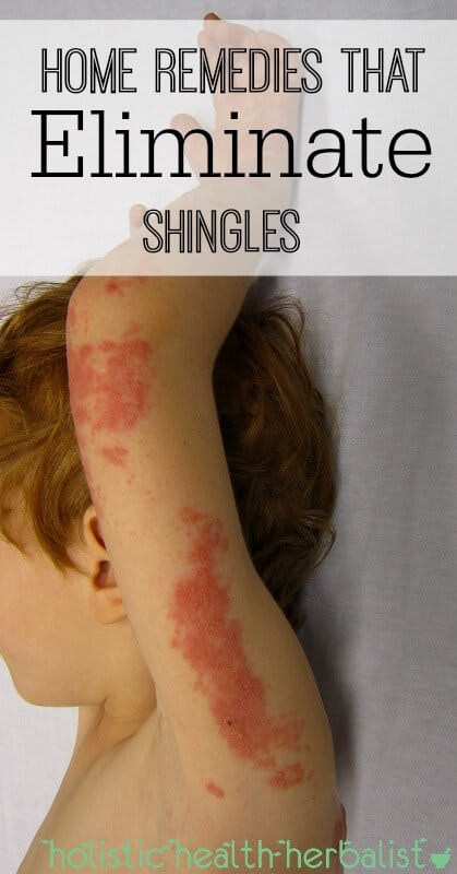 Home Remedies That Eliminate Shingles - Shingles can be a debilitating and painful condition caused by the varicella-zoster virus (the same virus that causes the chicken pox). Learn about the best home remedies to help ease symptoms and help you recover faster.